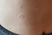 揭秘猫癣的症状及治疗方法（猫癣症状详解，帮你全面了解宠物健康）